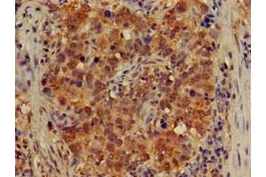 Immunohistochemistry of paraffin-embedded human pancreatic cancer using ABIN7149021 at dilution of 1:100 (ATG4B anticorps  (AA 350-400))