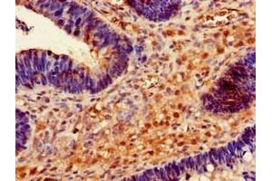 Immunohistochemistry of paraffin-embedded human ovarian cancer using ABIN7167713 at dilution of 1:100 (RMND1 anticorps  (AA 35-160))