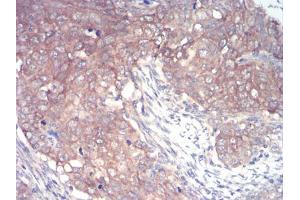 Immunohistochemical analysis of paraffin-embedded cervical cancer tissues using IRAK3 mouse mAb with DAB staining. (IRAK3 anticorps  (AA 454-596))
