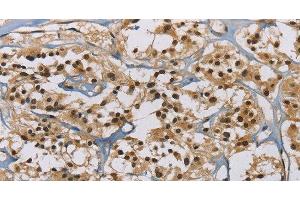 Immunohistochemistry of paraffin-embedded Human thyroid cancer tissue using ACVR1 Polyclonal Antibody at dilution 1:60 (ACVR1 anticorps)