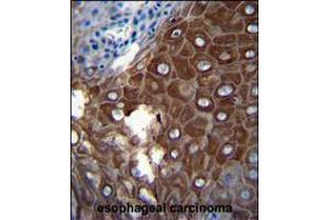 MMP1 Antibody immunohistochemistry analysis in formalin fixed and paraffin embedded human esophageal carcinoma followed by peroxidase conjugation of the secondary antibody and DAB staining. (MMP1 anticorps  (AA 317-347))