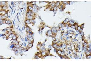 Immunohistochemistry of paraffin-embedded Human lung cancer using MTIF2 Polyclonal Antibody at dilution of 1:100 (40x lens). (MTIF2 anticorps)