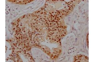 IHC image of ABIN7127775 diluted at 1:100 and staining in paraffin-embedded human prostate cancer performed on a Leica BondTM system. (Recombinant PRMT5 anticorps)