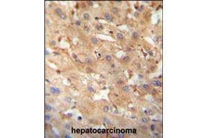 NEU4 antibody immunohistochemistry analysis in formalin fixed and paraffin embedded human hepatocarcinoma followed by peroxidase conjugation of the secondary antibody and DAB staining.