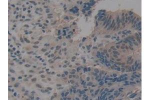 Detection of gp210 in Human Colorectal cancer Tissue using Polyclonal Antibody to Nuclear Pore Glycoprotein 210 (gp210)