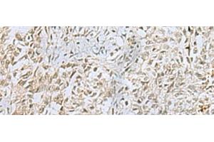 Immunohistochemistry of paraffin-embedded Human ovarian cancer tissue using FOXQ1 Polyclonal Antibody at dilution of 1:25(x200) (FOXQ1 anticorps)