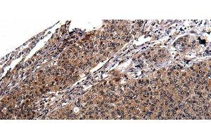 Immunohistochemistry of paraffin-embedded Human cervical cancer tissue using RAB41 Polyclonal Antibody at dilution 1:100 (RAB41 anticorps)