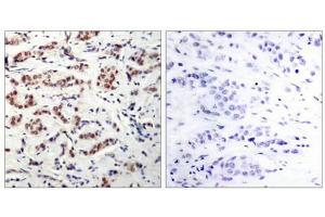 Immunohistochemical analysis of paraffin-embedded human breast carcinoma tissue using STAT5A(Phospho-Tyr694) Antibody(left) or the same antibody preincubated with blocking peptide(right). (STAT5A anticorps  (pTyr694))
