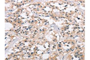 The image on the left is immunohistochemistry of paraffin-embedded Human thyroid cancer tissue using ABIN7190329(COL7A1 Antibody) at dilution 1/25, on the right is treated with synthetic peptide. (COL7A1 anticorps)