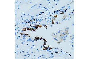 Immunohistochemistry of paraffin-embedded human lung cancer using CTSE antibody (ABIN5971444) at dilution of 1/100 (40x lens). (Cathepsin E anticorps)
