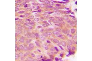 Immunohistochemical analysis of Transglutaminase 2 staining in human breast cancer formalin fixed paraffin embedded tissue section.