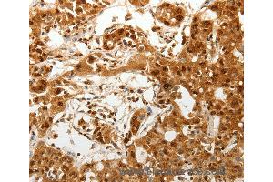 Immunohistochemistry of Human lung cancer using TENM3 Polyclonal Antibody at dilution of 1:50 (TENM3 anticorps)