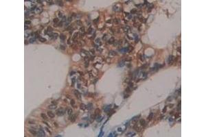 IHC-P analysis of Human Tissue, with DAB staining. (BMI1 anticorps  (AA 152-289))