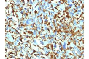 Formalin-fixed, paraffin-embedded human Histiocytoma stained with Factor XIIIa Mouse Monoclonal Antibody (F13A1/1448). (F13A1 anticorps  (AA 46-181))
