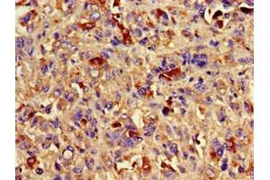 Immunohistochemistry of paraffin-embedded human melanoma using ABIN7145083 at dilution of 1:100