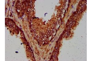 IHC image of ABIN7166132 diluted at 1:600 and staining in paraffin-embedded human prostate cancer performed on a Leica BondTM system.