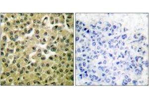 Immunohistochemistry analysis of paraffin-embedded human breast carcinoma tissue, using MCL1 Antibody. (MCL-1 anticorps  (AA 91-140))