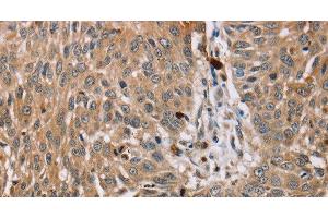 Immunohistochemistry of paraffin-embedded Human lung cancer tissue using PDLIM7 Polyclonal Antibody at dilution 1:35 (PDLIM7 anticorps)