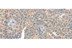 Immunohistochemistry of paraffin-embedded Human ovarian cancer tissue using PPP3R1 Polyclonal Antibody at dilution of 1:55(x200) (PPP3R1 anticorps)
