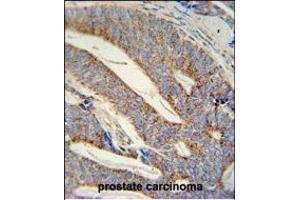 DACT1 antibody (N-term) (ABIN652102 and ABIN2840549) immunohistochemistry analysis in formalin fixed and paraffin embedded human prostate carcinoma followed by peroxidase conjugation of the secondary antibody and DAB staining.