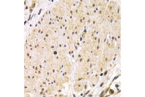 Immunohistochemistry of paraffin-embedded human stomach cancer using TMPRSS2 antibody (ABIN5975349) at dilution of 1/200 (40x lens). (TMPRSS2 anticorps)