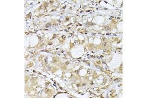 Immunohistochemistry of paraffin-embedded human liver cancer using PSM antibody (ABIN1682332, ABIN3018467, ABIN3018468 and ABIN6220474) at dilution of 1:100 (40x lens).
