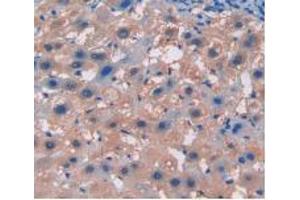 IHC-P analysis of Human Liver Cancer Tissue, with DAB staining. (Integrin beta 5 anticorps  (AA 137-378))