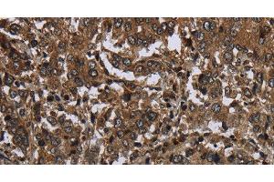 Immunohistochemistry of paraffin-embedded Human liver cancer tissue using GLIPR1 Polyclonal Antibody at dilution 1:50 (GLIPR1 anticorps)