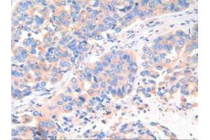 IHC-P analysis of Human Breast Cancer Tissue, with DAB staining. (Cathepsin K anticorps  (AA 54-317))
