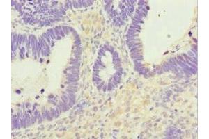 Immunohistochemistry of paraffin-embedded human ovarian cancer using ABIN7161949 at dilution of 1:100