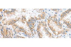 Immunohistochemistry of paraffin-embedded Human lung cancer tissue using RIDA Polyclonal Antibody at dilution of 1:65(x200) (HRSP12 anticorps)