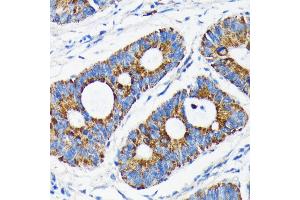 Immunohistochemistry of paraffin-embedded human colon carcinoma using Bax antibody (ABIN7265858) at dilution of 1:100 (40x lens).