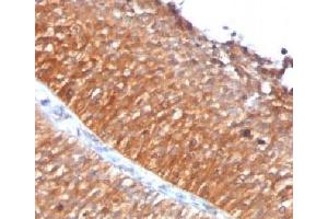 IHC testing of FFPE human bladder carcinoma with Mitochondrial antibody (GFM1 anticorps)