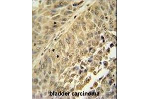 HNRNPC antibody (C-term) (ABIN654685 and ABIN2844378) immunohistochemistry analysis in formalin fixed and paraffin embedded human bladder carcinoma followed by peroxidase conjugation of the secondary antibody and DAB staining. (HNRNPC anticorps  (C-Term))