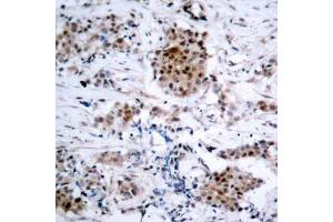 Immunohistochemistry of paraffin-embedded human breast carcinoma using Phospho-ESR1-S167 antibody (ABIN2988007). (Estrogen Receptor alpha anticorps  (pSer167))