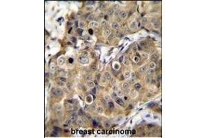 TME Antibody (C-term) (ABIN655659 and ABIN2845131) immunohistochemistry analysis in formalin fixed and paraffin embedded human breast carcinoma followed by peroxidase conjugation of the secondary antibody and DAB staining. (TMEM100 anticorps  (C-Term))