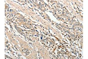 The image on the left is immunohistochemistry of paraffin-embedded Human gastric cancer tissue using ABIN7189660(ADAMTS2 Antibody) at dilution 1/25, on the right is treated with synthetic peptide.