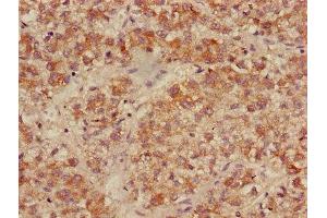 Immunohistochemistry of paraffin-embedded human liver cancer using ABIN7158499 at dilution of 1:100 (ACADL anticorps  (AA 30-260))