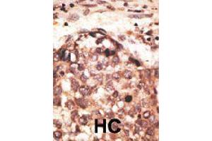 Formalin-fixed and paraffin-embedded human hepatocellular carcinoma tissue reacted with MMP8 polyclonal antibody  , which was peroxidase-conjugated to the secondary antibody, followed by AEC staining. (MMP8 anticorps  (Internal Region))
