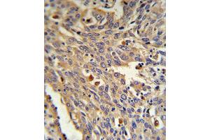 GLA Antibody IHC analysis in formalin fixed and paraffin embedded human Lung carcinoma followed by peroxidase conjugation of the secondary antibody and DAB staining. (GLA anticorps  (N-Term))