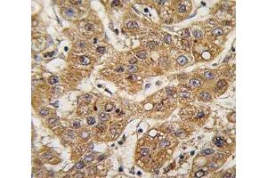 IHC analysis of FFPE human hepatocarcinoma tissue stained with ApoE antibody