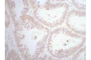Immunohistochemistry (IHC) staining of human rectal cancer tissue, diluted at 1:200. (CDX2 anticorps)