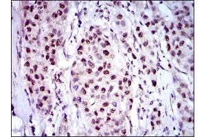 Immunohistochemical analysis of paraffin-embedded liver cancer tissues using NAPSA mouse mAb with DAB staining.