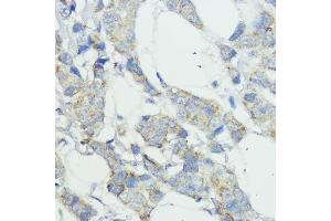 Immunohistochemistry of paraffin-embedded human mammary cancer using NOD1 antibody (ABIN3021837, ABIN3021838, ABIN3021839 and ABIN6216095) at dilution of 1:100 (40x lens).
