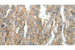 Immunohistochemistry of paraffin-embedded Human ovarian cancer tissue using PRDX5 Polyclonal Antibody at dilution 1:40 (Peroxiredoxin 5 anticorps)