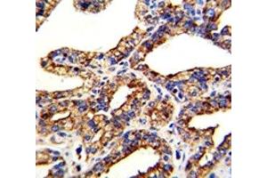 IHC analysis of FFPE human prostate carcinoma with TROP2 antibody