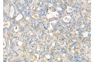 ABIN6257222 and ABIN6276028 at 1/100 staining Human liver cancer by IHC-P. (GPR17 anticorps  (C-Term))