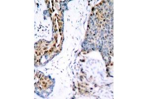 Immunohistochemistry of paraffin-embedded human breast carcinoma using Phospho-ESR1-S118 antibody (ABIN2987431). (Estrogen Receptor alpha anticorps  (pSer118))