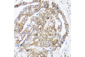Immunohistochemistry of paraffin-embedded human liver cancer using BCAP29 antibody. (BCAP29 anticorps  (AA 125-241))
