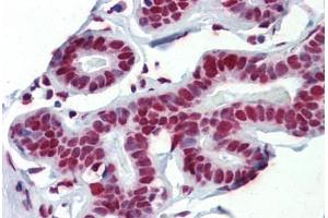 Human Breast (formalin-fixed, paraffin-embedded) stained with FUS antibody ABIN462224 followed by biotinylated goat anti-rabbit IgG secondary antibody ABIN481713, alkaline phosphatase-streptavidin and chromogen.